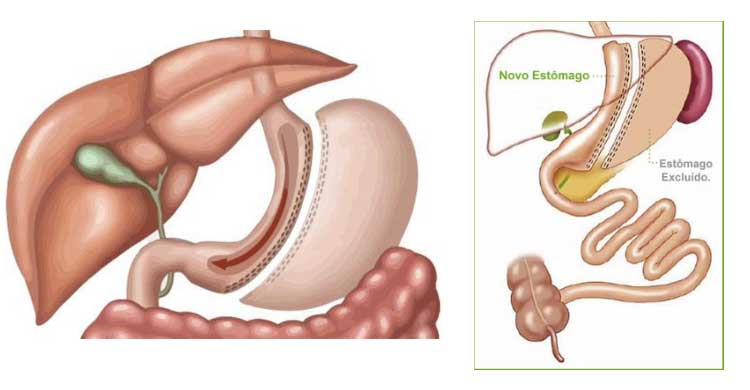 Sleeve Gastrectomia Vertical