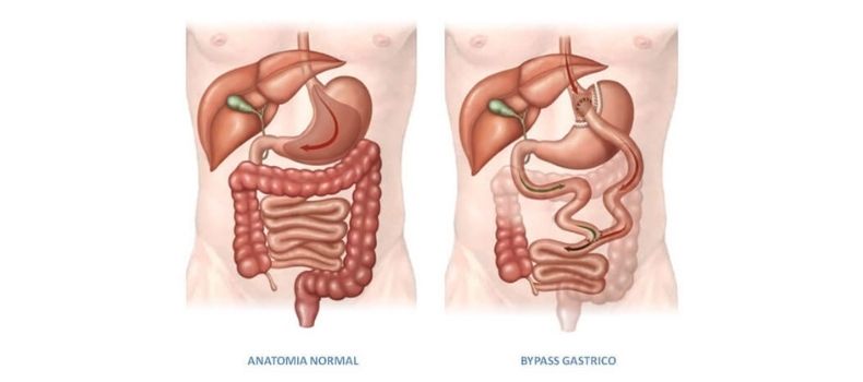 Bypass Gástrico